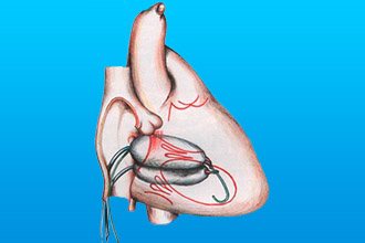 Органосберегающая вальвулопластика при аортальном пороке сердца