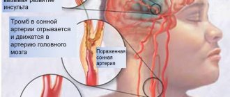 осложнения при заболевании сонной артерии