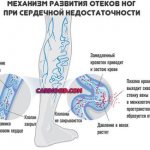 отеки-ног-при-сердечной-недостаточности