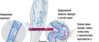 отеки-ног-при-сердечной-недостаточности