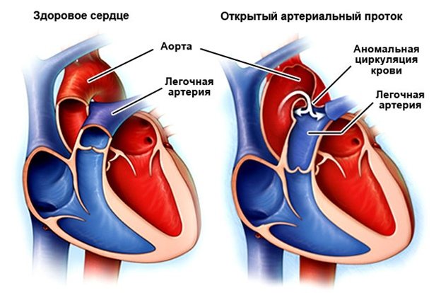 Открытый артериальный проток. Что это? | ВКонтакте
