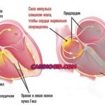 отмирание клеток синусового узла