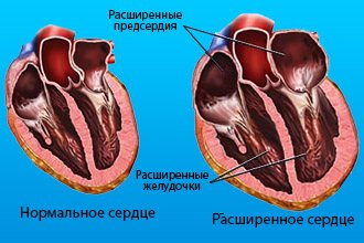 Патологический процесс сердца
