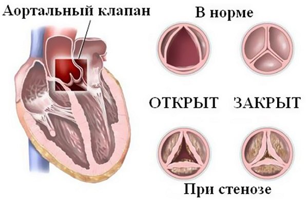 Патология сердечных клапанов