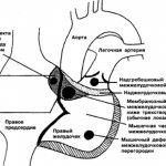 Перимембранозный дефект межжелудочковой перегородки