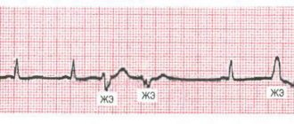 Полиморфные желудочковые экстрасистолы (ЖЭ)