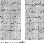 Полная блокада правой ножки пучка Гиса