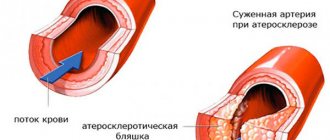 Поражение артерии атеросклерозом