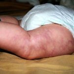 Повышенная кровоточивость у ребенка с тромбоцитопенией