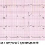 Пример пленки с синусовой брадикардией