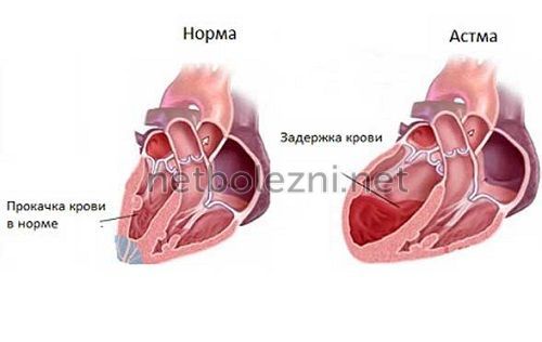 Проявление сердечной астмы