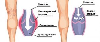 Работа клапанов при хронической венозной недостаточности