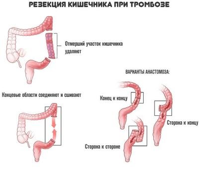 Резекция кишечника при тромбозе