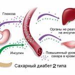 Сахарный диабет второго типа: признаки, лечение