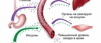 Сахарный диабет второго типа: признаки, лечение