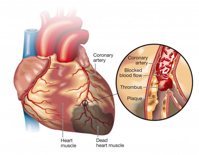 схема инфаркта миокарда
