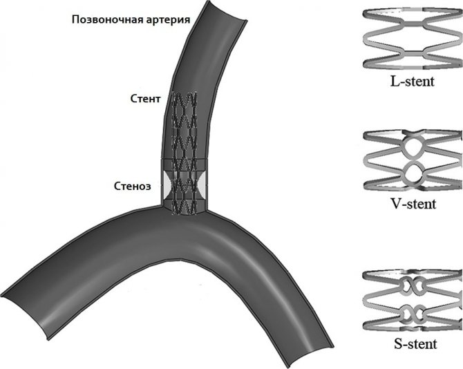 Схема стентирования позвоночной артерии