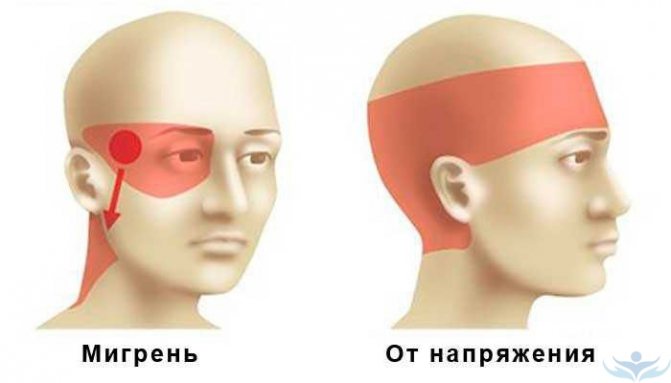 Схематическое изображение локализации болей при мигрени и головной боли напряжения