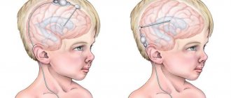 Шунтирование головного мозга при гидроцефалии: описание процедуры, назначение, возможные последствия операции, прогнозы