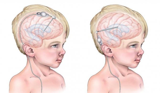 Шунтирование головного мозга при гидроцефалии: описание процедуры, назначение, возможные последствия операции, прогнозы