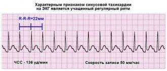 синусовая тахикардия на экг