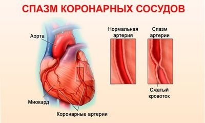 Спазм коронарных артерий