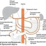 Стеноз.атеросклероз 1 .jpg