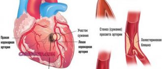 стеноз-коронарных-артерий