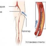 стентирование