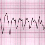 Трепетание желудочков на электрокардиограмме