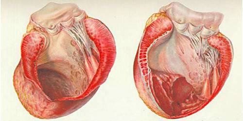 тромбэктомия сердца