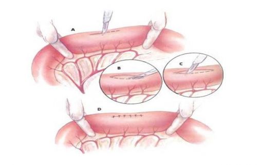 Удаление участков тонкой кишки - один из методов хирургического лечения при инфаркте кишечника