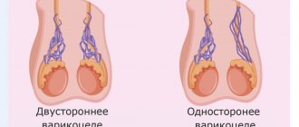 Варикоцеле разной локализации