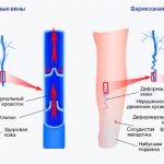 Варикозное расширение вен