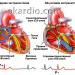 виды наджелудочковой экстрасистолии