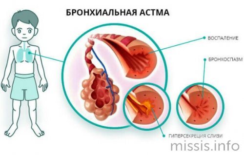 Заболевание бронхиальная астма