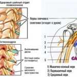 защемление-нервов-при-остеохондрозе
