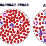 Здоровая кровь и кровь с лейкозом