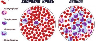Здоровая кровь и кровь с лейкозом