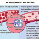 железодефицитная анемия