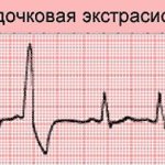 Желудочковая экстрасистолия